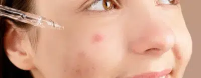 Anti Acne Serum