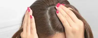 Anti Dandruff Shampoo