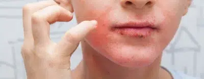Dry And Rough Skin