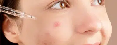 Acne Serum