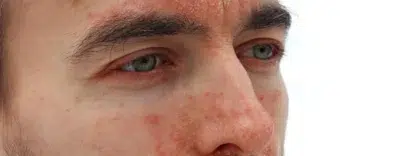 Seborrheic Eczema