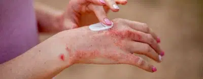 Hand Eczema