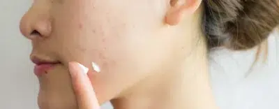 Acne Gel
