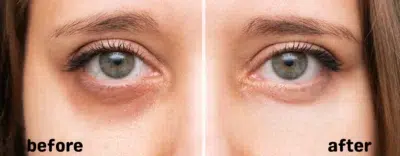 Dark Circles