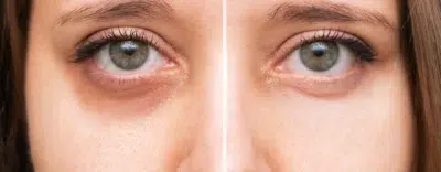 Dark Eye Circles