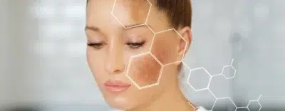 Melasma Cream