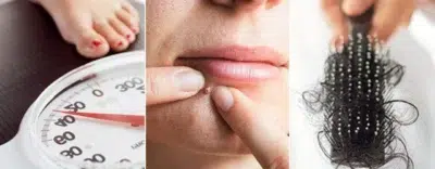 Pcos: Unveiling The Skin, Hair, And Hormonal Imbalance Beauty