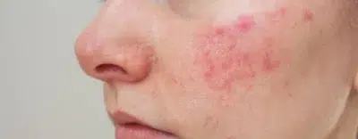 Psoriasis
