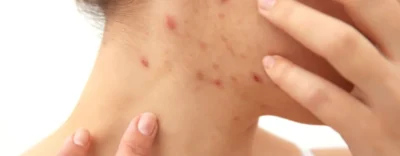 Scabies