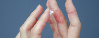 Onvate Lotion