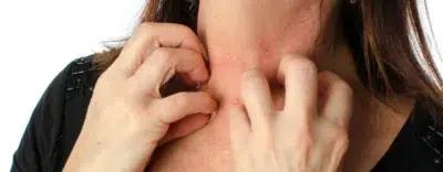 Urticaria