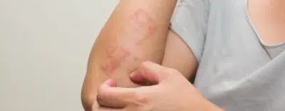 Lichen Planus