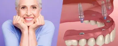 Dental Implants