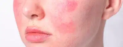 Living With Rosacea: A Guide To Managing The Chronic Facial Skin Condition Skincare
