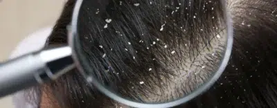Dandruff