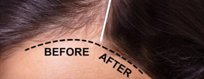 Diffuse Hair Loss In Women: Understanding The Cause &Amp; Finding Solutions Beauty