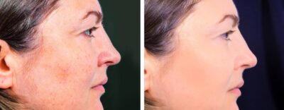 Open Pores