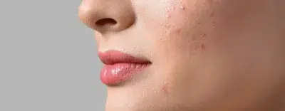 Acne Cream
