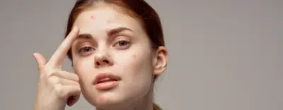 Acne Treatment