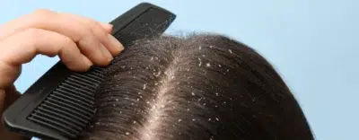 Anti Dandruff