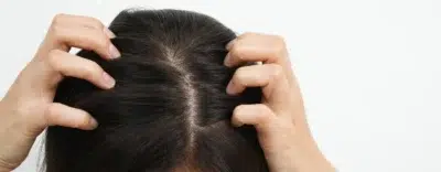 Dandruff