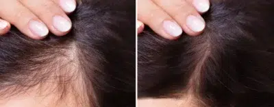 Understanding Hair Loss: Exploring Causes, Treatments, And Prevention Hair Care