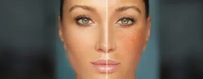 Biorepeel For Melamsa: Emerging Treatment Option Aesthetic Procedures