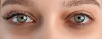 Micro Needling For Dark Eye Circles