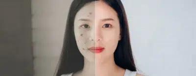 Oily Skin
