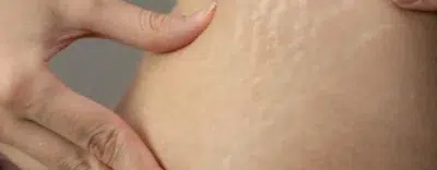 Stretch Marks