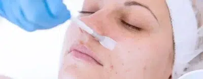 Chemical Peeling