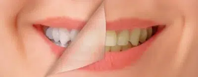 The Art And Science Of Smile Design: A Dentist'S Guide To Crafting Beautiful Smiles Dental Bonding