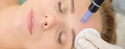Microneedling