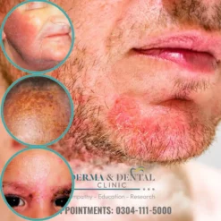 Expert Care for Seborrheic Eczema at Derma & Dental Clinic
