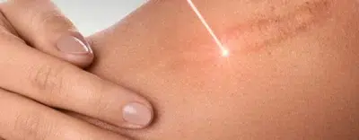 Keloid Fractional Co2
