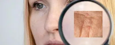 Sebaceous Hyperplasia
