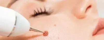 Fractional Co2 Laser