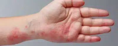 Scabies