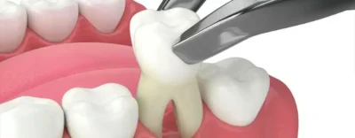 Tooth Extraction