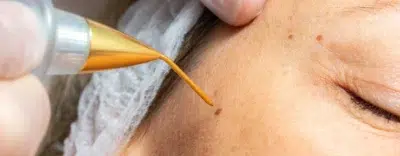 Wart-Off Lotion: Your Solution For Wart, Corn, And Callus Treatment Dental Bonding