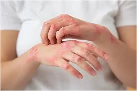 fungal infection