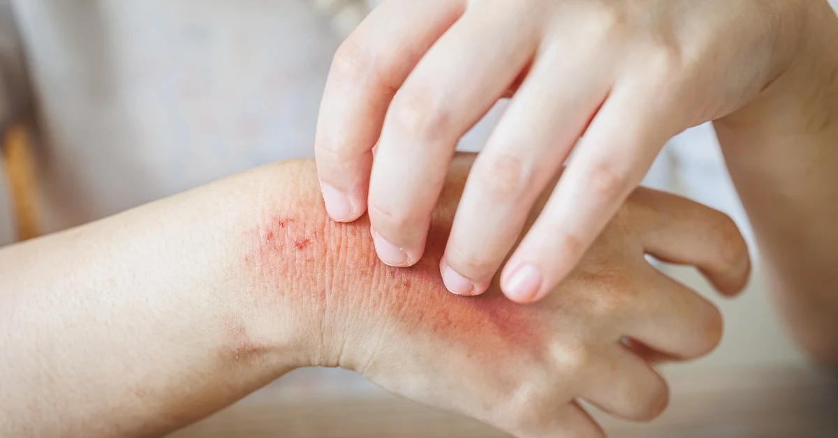 What Is Hydrozole Cream Used For? Benefits Explained 1 Hydrozole Cream