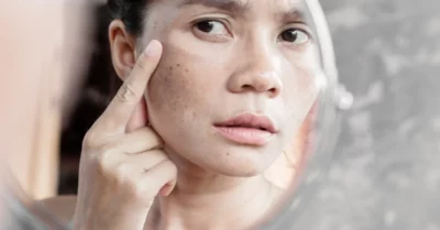 Pigmentation