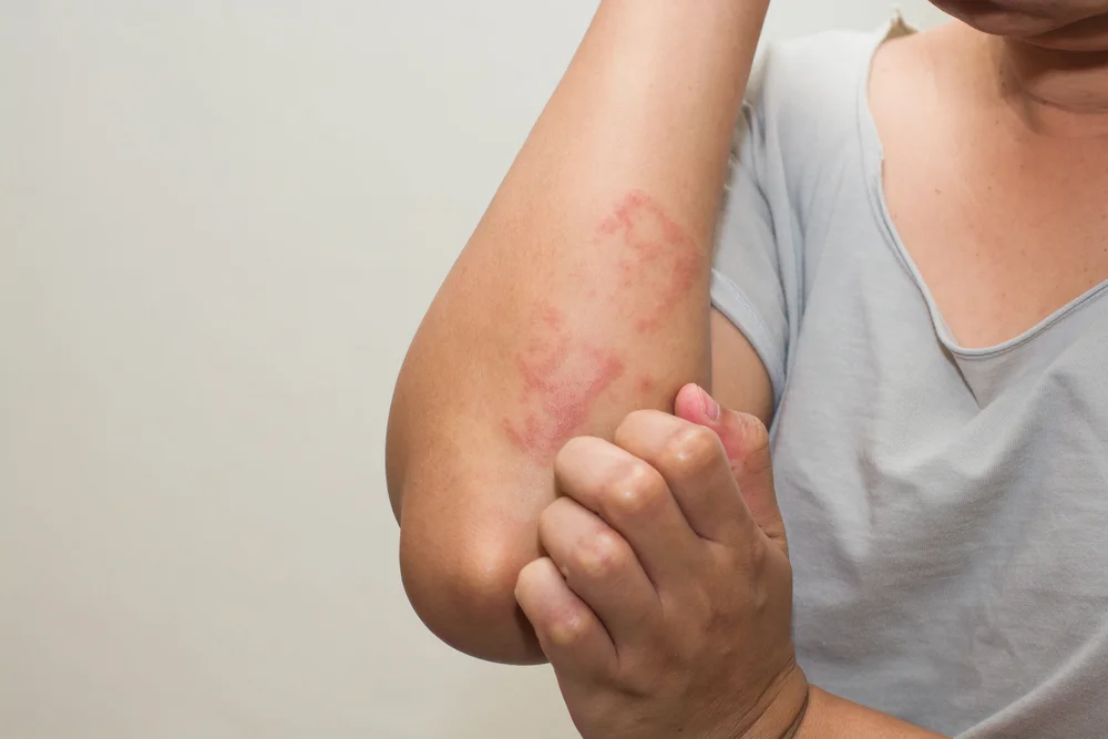 Lotion For Scabies Treatment – Fast Relief &Amp; Itch Control 2 Scabies Treatment