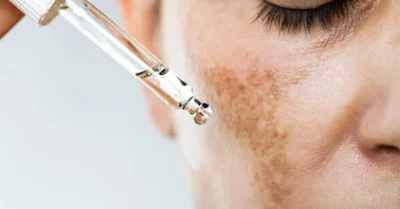 Skin Melasma