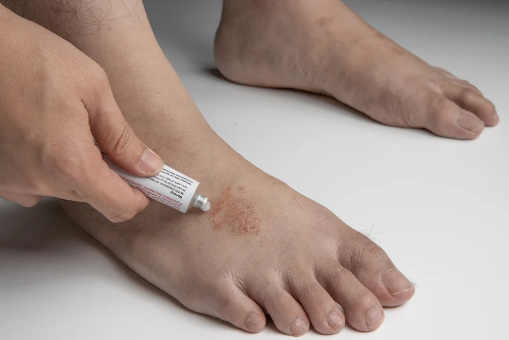 What Is Hydrozole Cream Used For? Benefits Explained 2 Antifungal-Cream