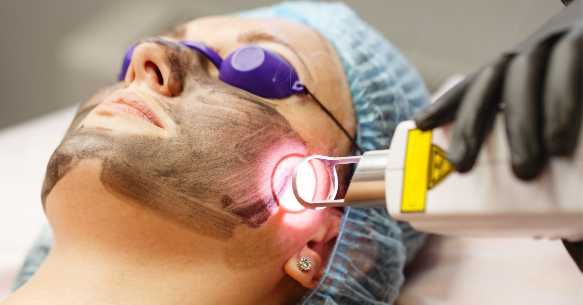 Melasma Treatment: 3 Best Cream In Pakistan 1 Melasma Treatment