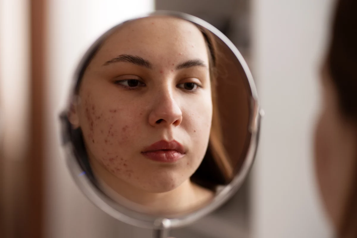Adapco Cream Benefits: Improve Skin Health Fast 2 Adapco Cream